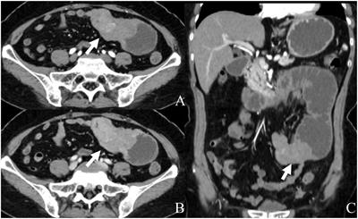 Primary Ewing’s sarcoma of the intestine: case report and literature review